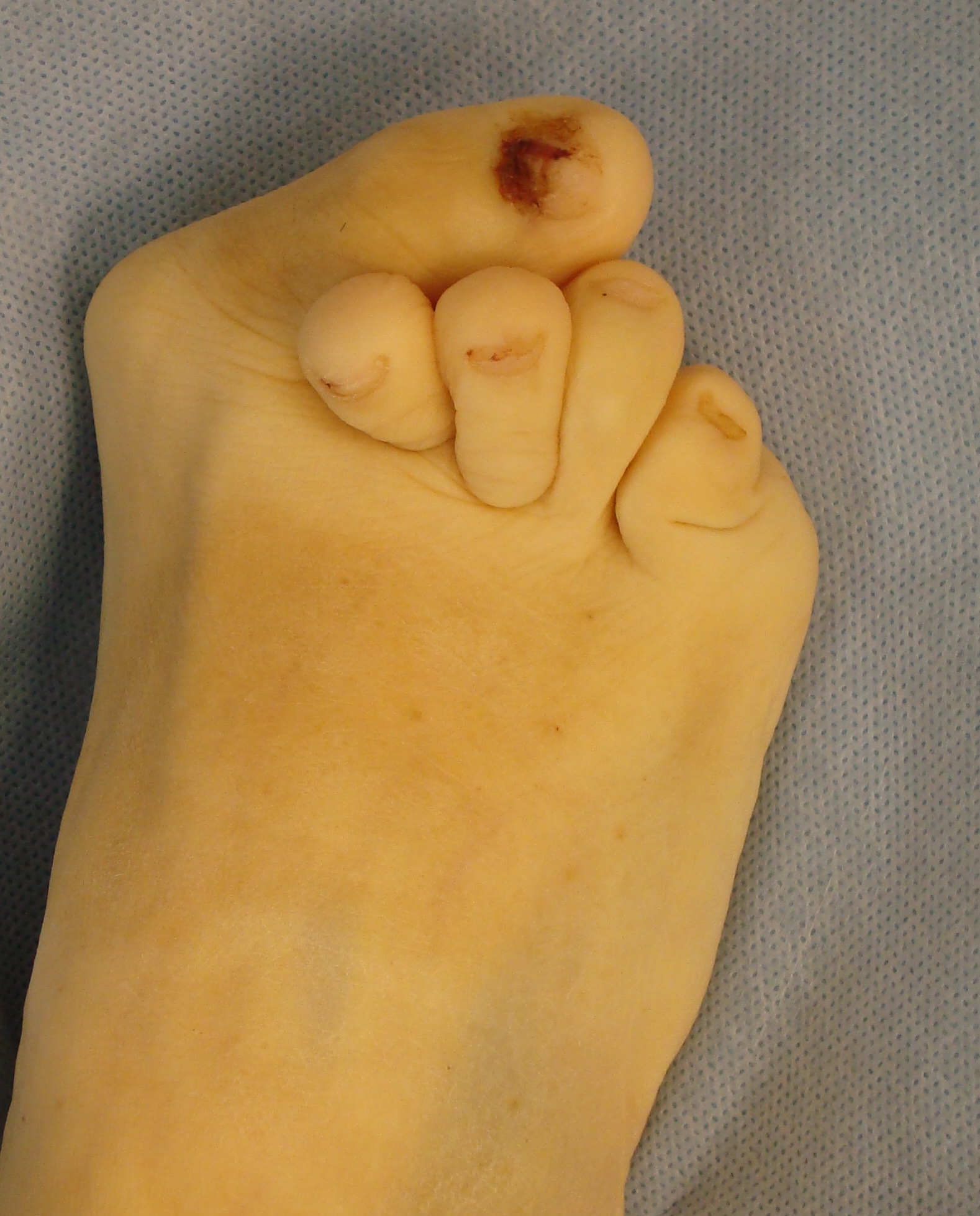 Foot with Rheumatoid Arthritis