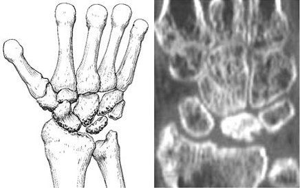 Kienböck's disease stage 4