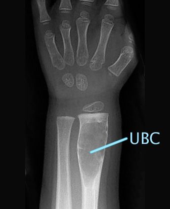 X-ray of unicameral bone cyst on wrist