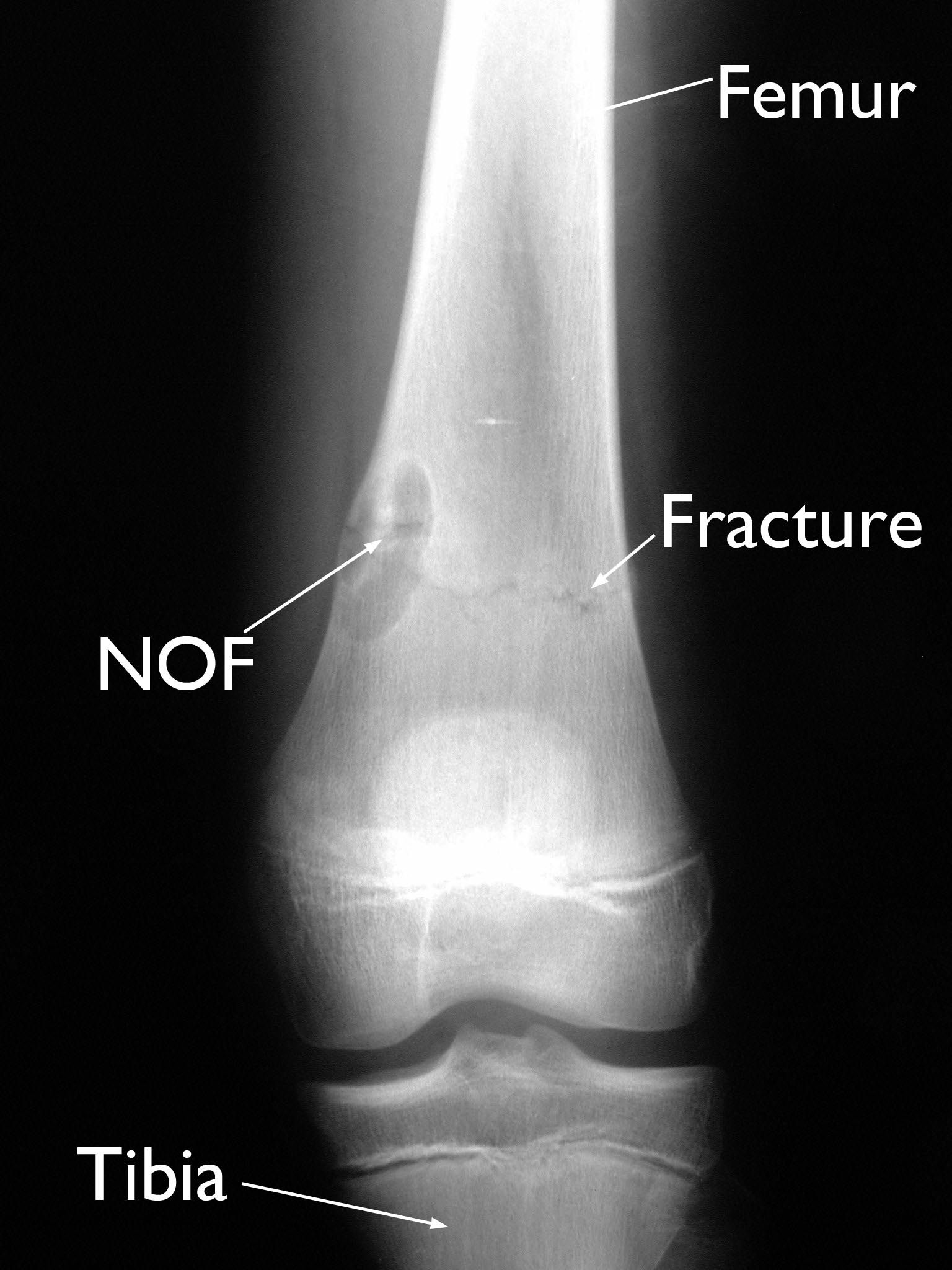 NOF and pathologic fracture in femur