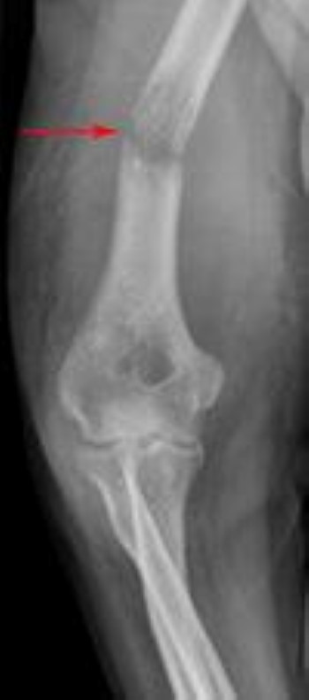 Pathologic fracture