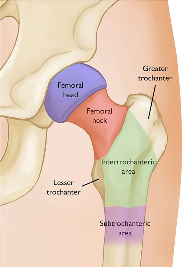 Hip Fractures - OrthoInfo - AAOS