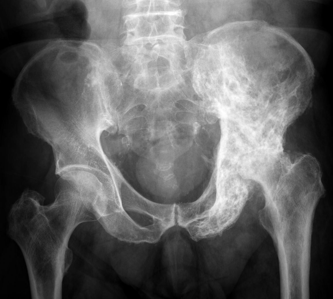 Paget's disease of the pelvis