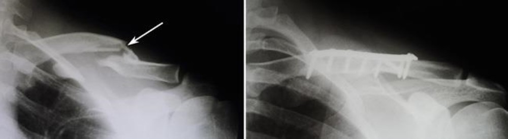 normal clavicle xray