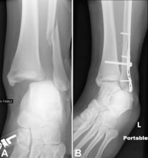 Medial & Lateral Malleolus Ankle Fracture - Physical Therapy Tips