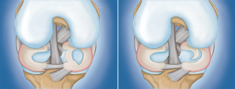 Posterior Cruciate Ligament Injuries - OrthoInfo - AAOS