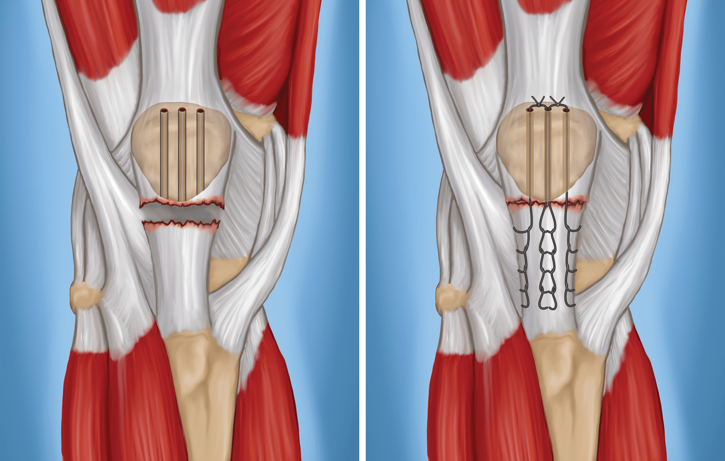 Patellar Tendon Tear - OrthoInfo - AAOS