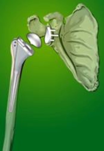 Shoulder joint replacement