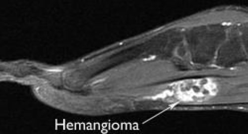 Hemangioma Orthoinfo Aaos