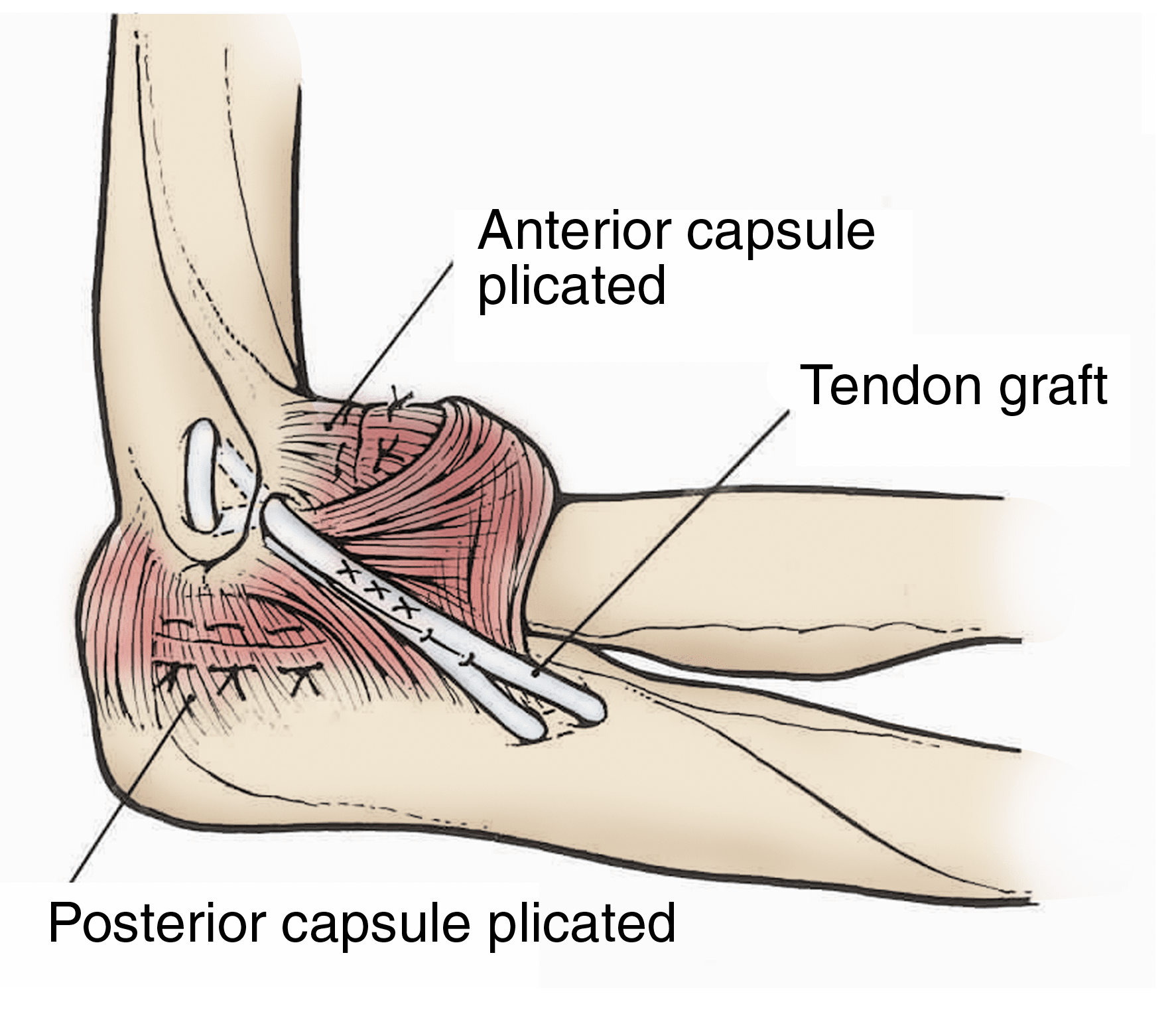 elbow ligament reconstruction