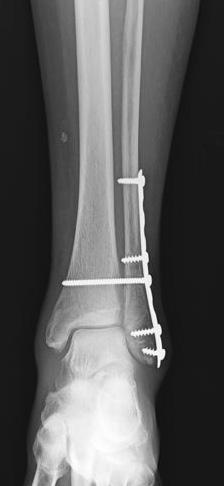 internal fixation of ankle fracture