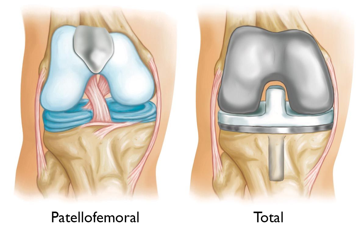 misshapen knee cap