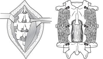 Espondilosis cervical (osteoartritis de cuello) (Cervical Spondylosis) -  OrthoInfo - AAOS