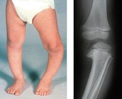 Photo and x-ray of child with Blount's disease
