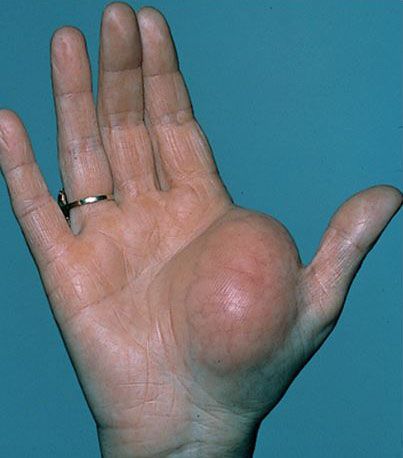 Foto de lipoma en mano.