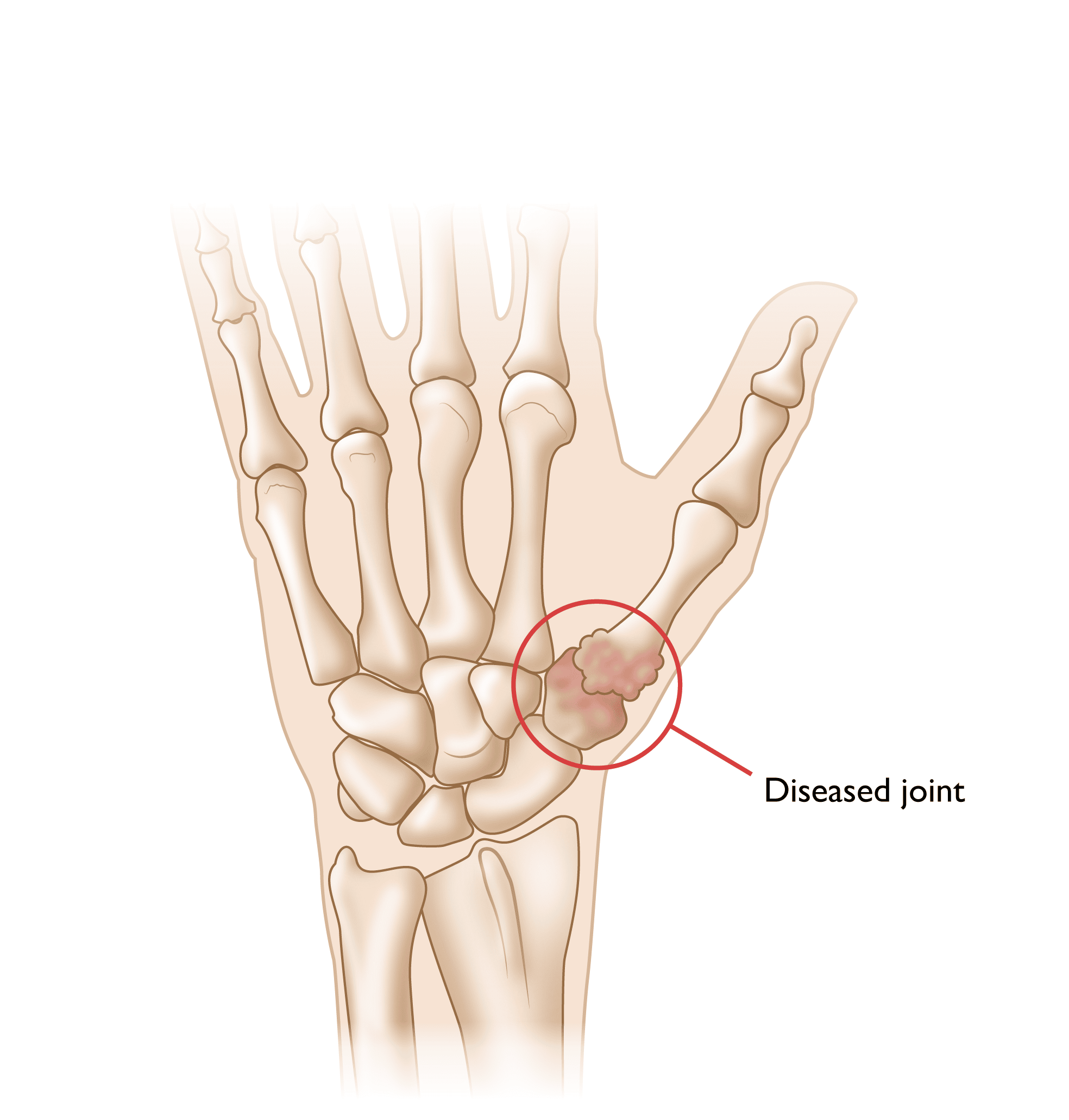 Illustration of arthritis at the base of the thum