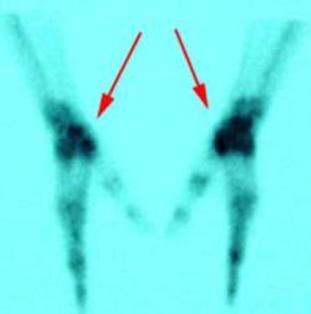 Bone scan showing arthritis of the hands