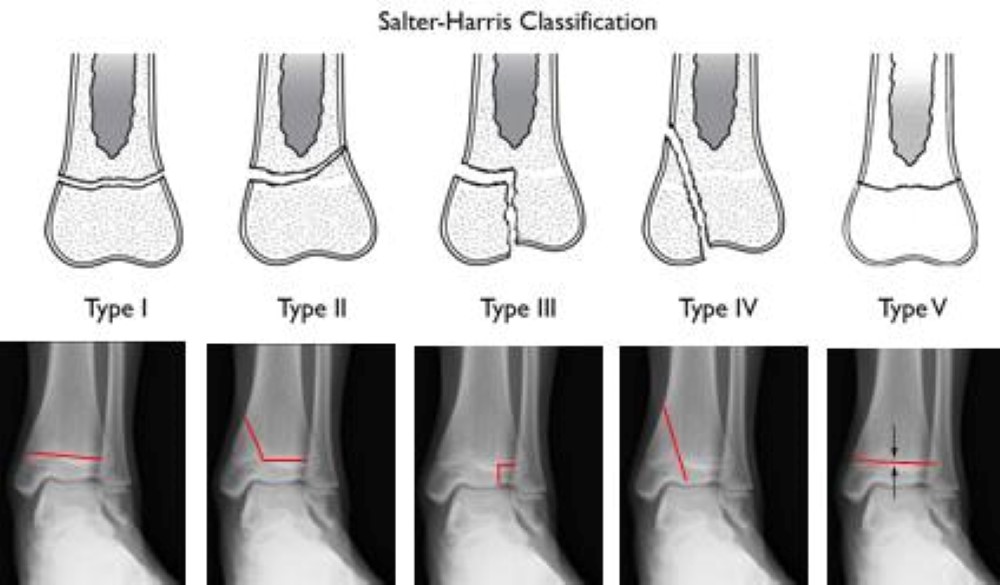 Ankle Fractures In Children - OrthoInfo - AAOS