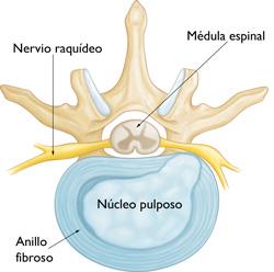 Hernia de disco en la zona lumbar