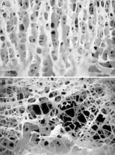photos of healthy and osteoporotic cancellous bone