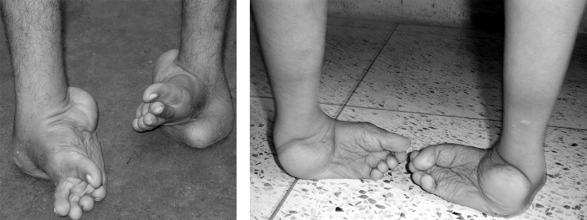 Clubfoot Orthoinfo Aaos 6613