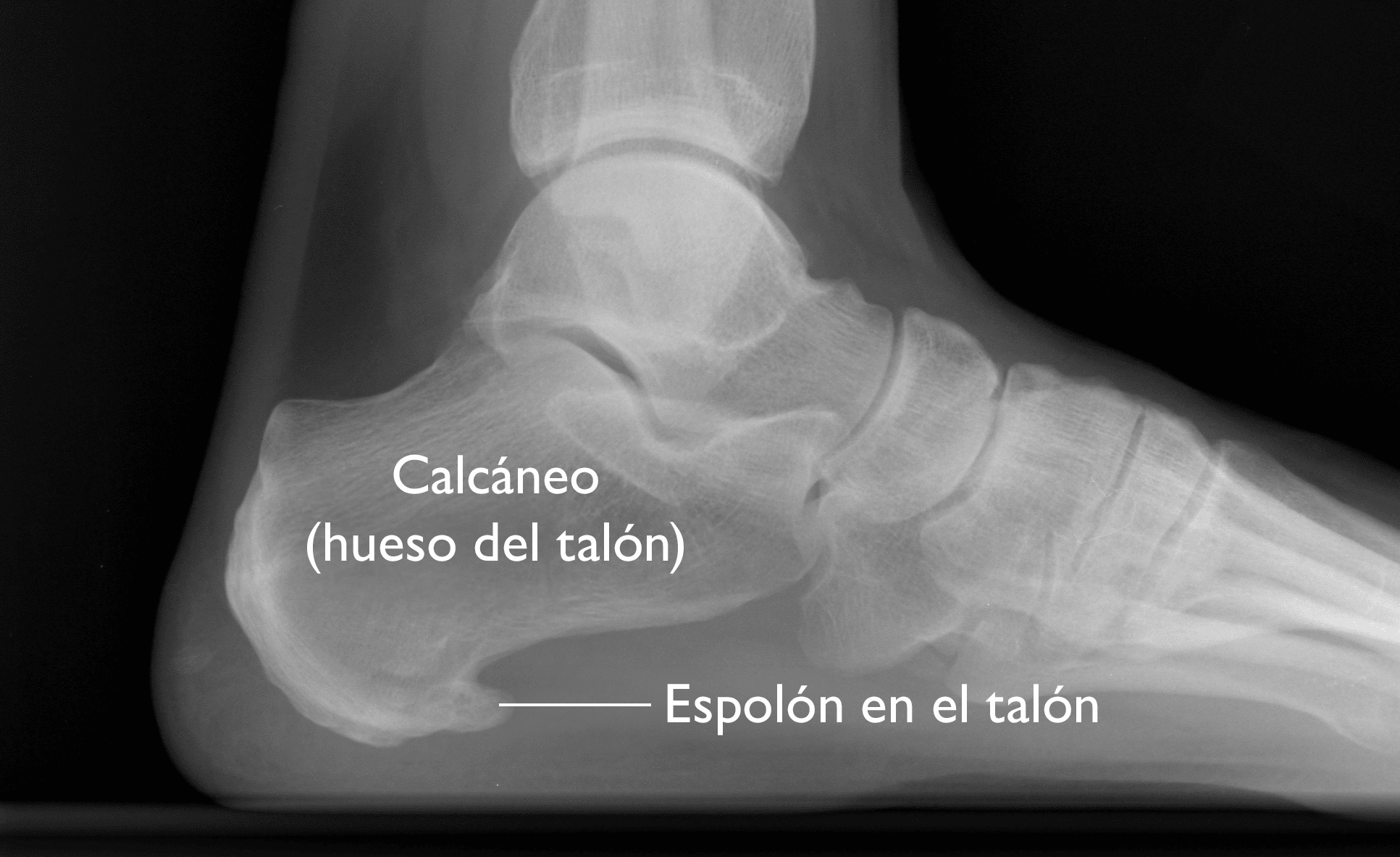 Fascitis plantar, espolones y edema óseo: ¿Cómo aliviar el dolor?