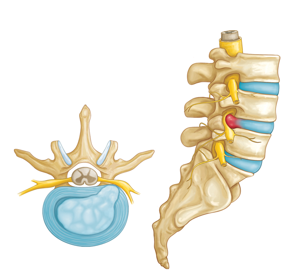 Illustration of a herniated disk