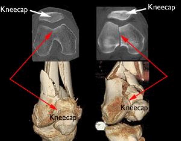 knee cap broken in half