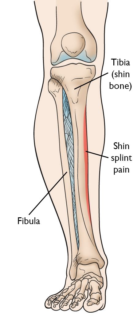 can i cycle with shin splints