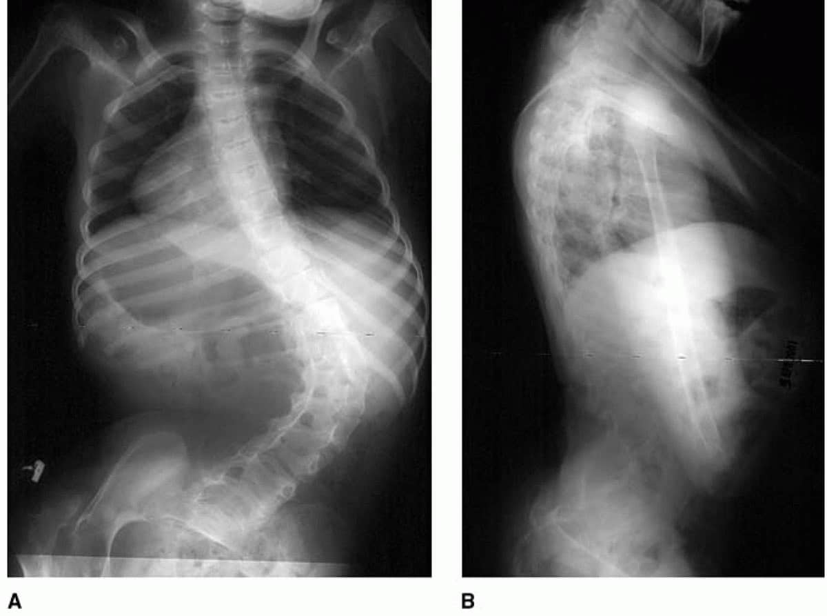 X-rays of a patient with cerebral palsy and scoliosis