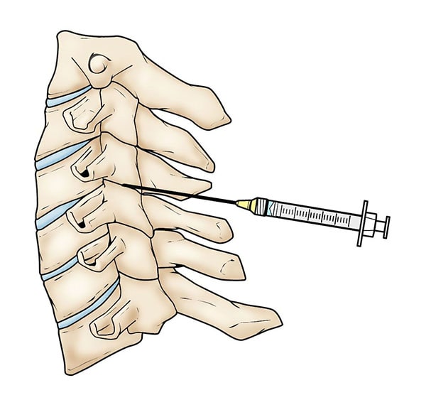 Facet joint injection in the cervical spine. 