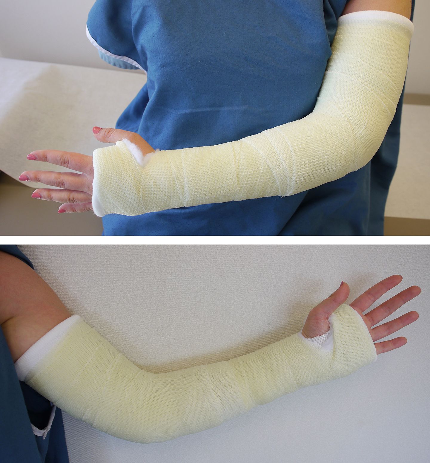 elbow fracture cast