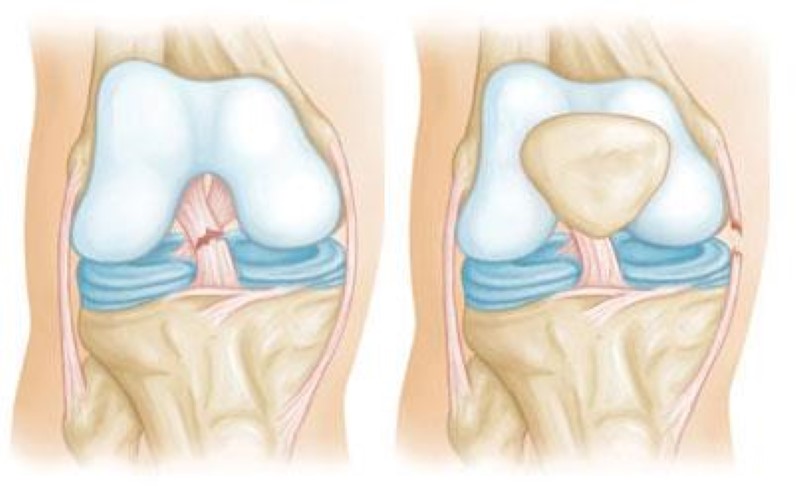 combined knee ligament tears