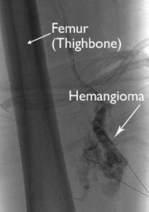 Hemangioma - OrthoInfo - AAOS