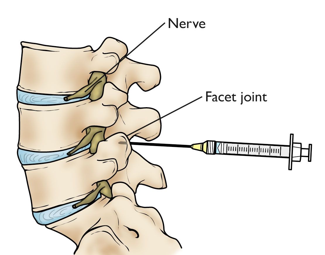 spinal facet injections