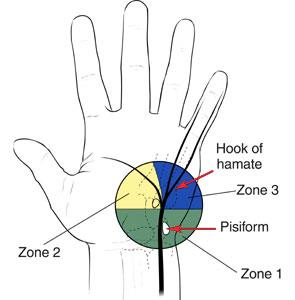 Image result for ULNAR TUNNEL SYNDROME