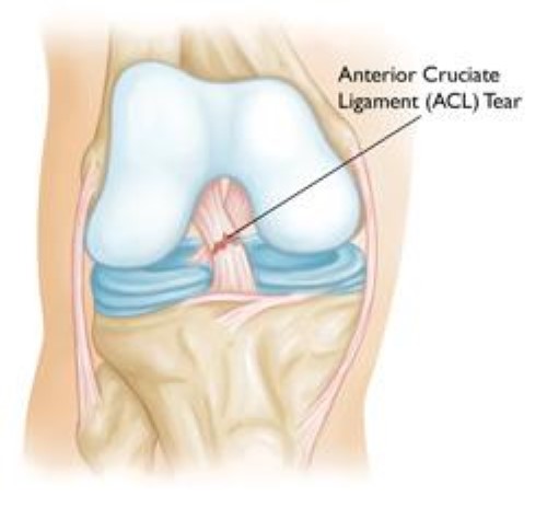 ACL tear