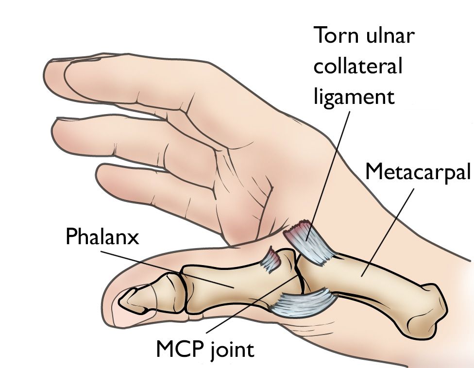 Sprained Thumb - OrthoInfo - AAOS