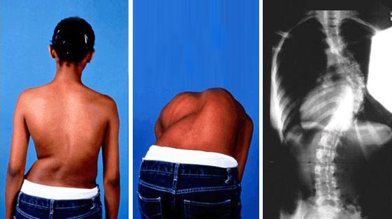 adolescent idiopathic scoliosis