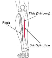 Location of pain from shin splints