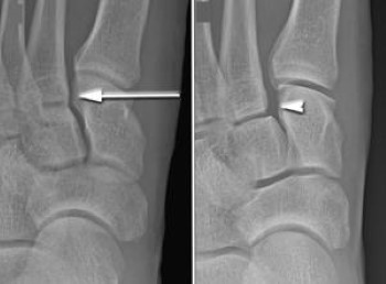 Lisfranc˵X