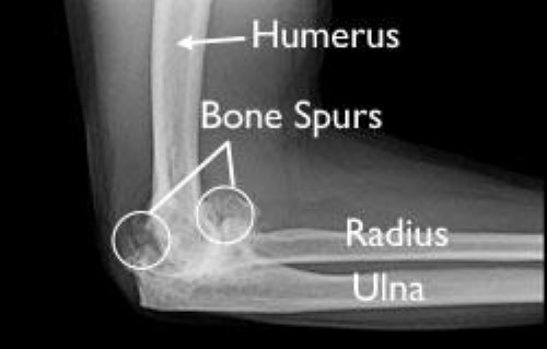 Elbow Arthroscopy Orthoinfo Aaos