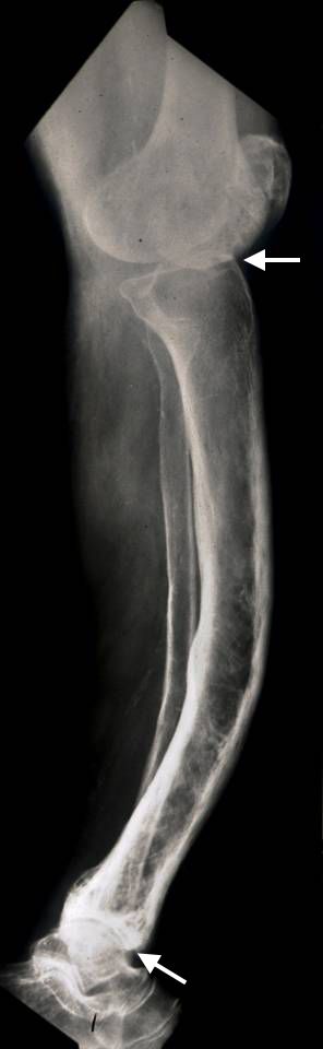 Paget's disease of the tibia
