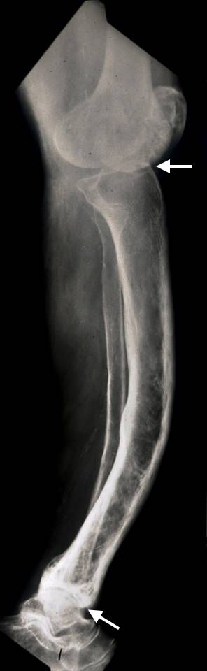 Paget's disease of bone  Causes, symptoms, treatments