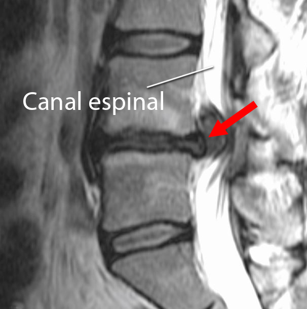 Hernia de disco en la zona lumbar