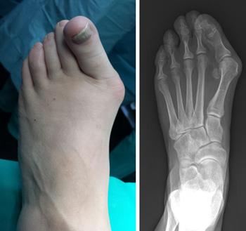 leg pain after bunion surgery