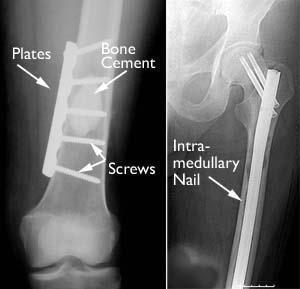 Internal fixation