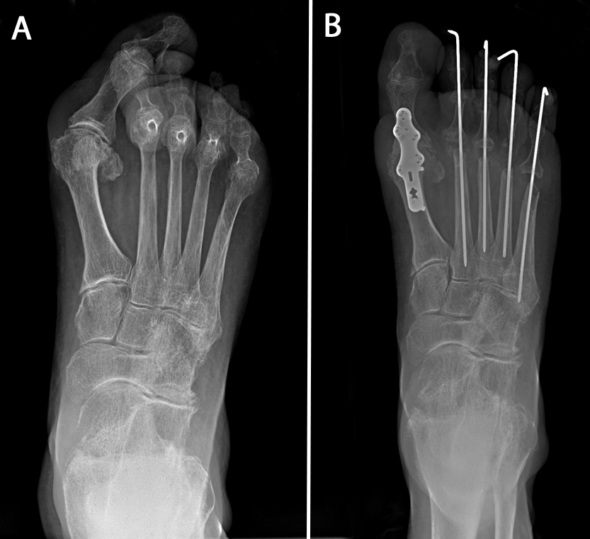 Rheumatoid Arthritis Feet Xray