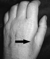 Cubital Tunnel Syndrome — Ability Hand to Shoulder Rehabilitation