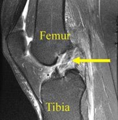 MRI of ACL tear